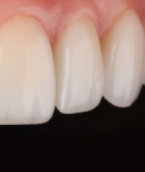 Dents après le traitement orthodontique