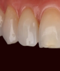 Dents avant le traitement orthodontique